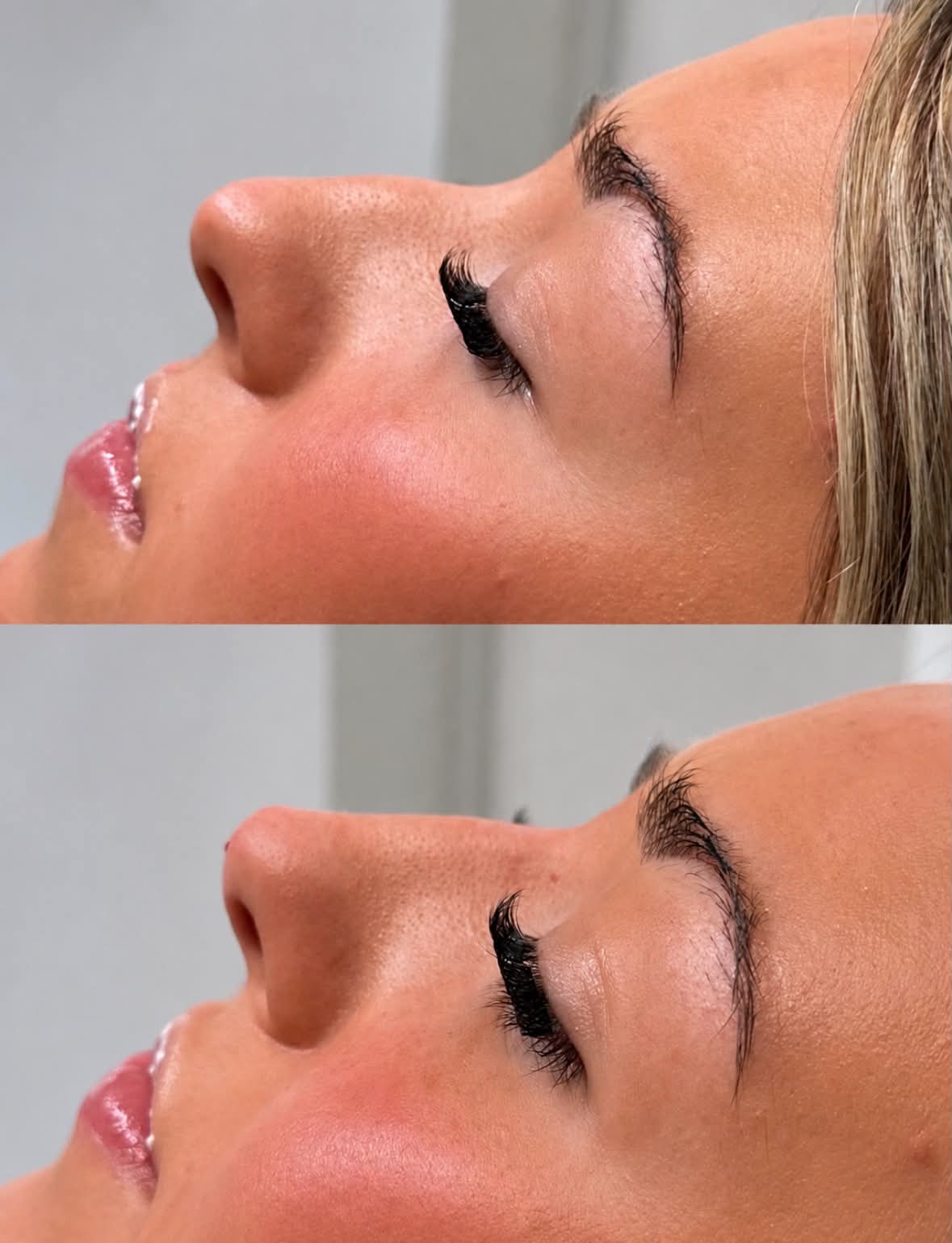Before and after an anti-wrinkle brow treatment, shown in profile