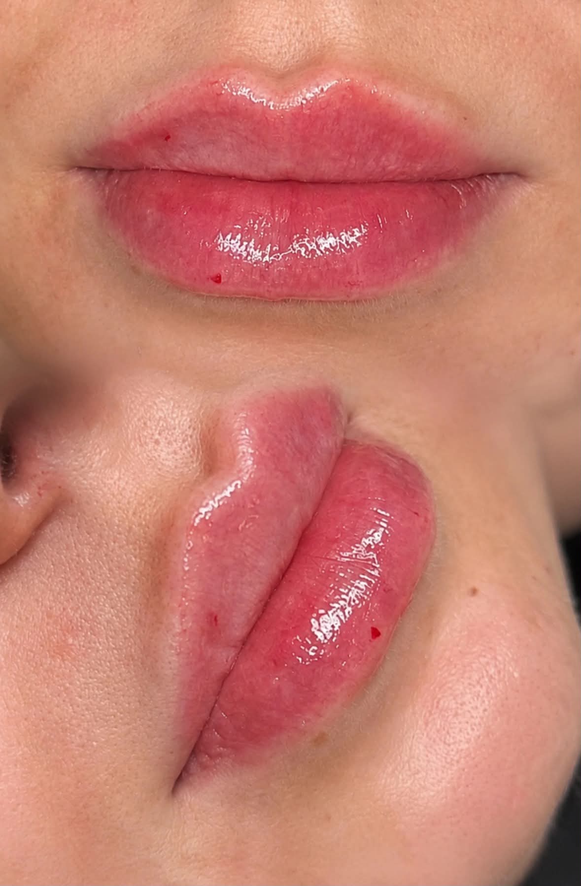 Lip filler before and after