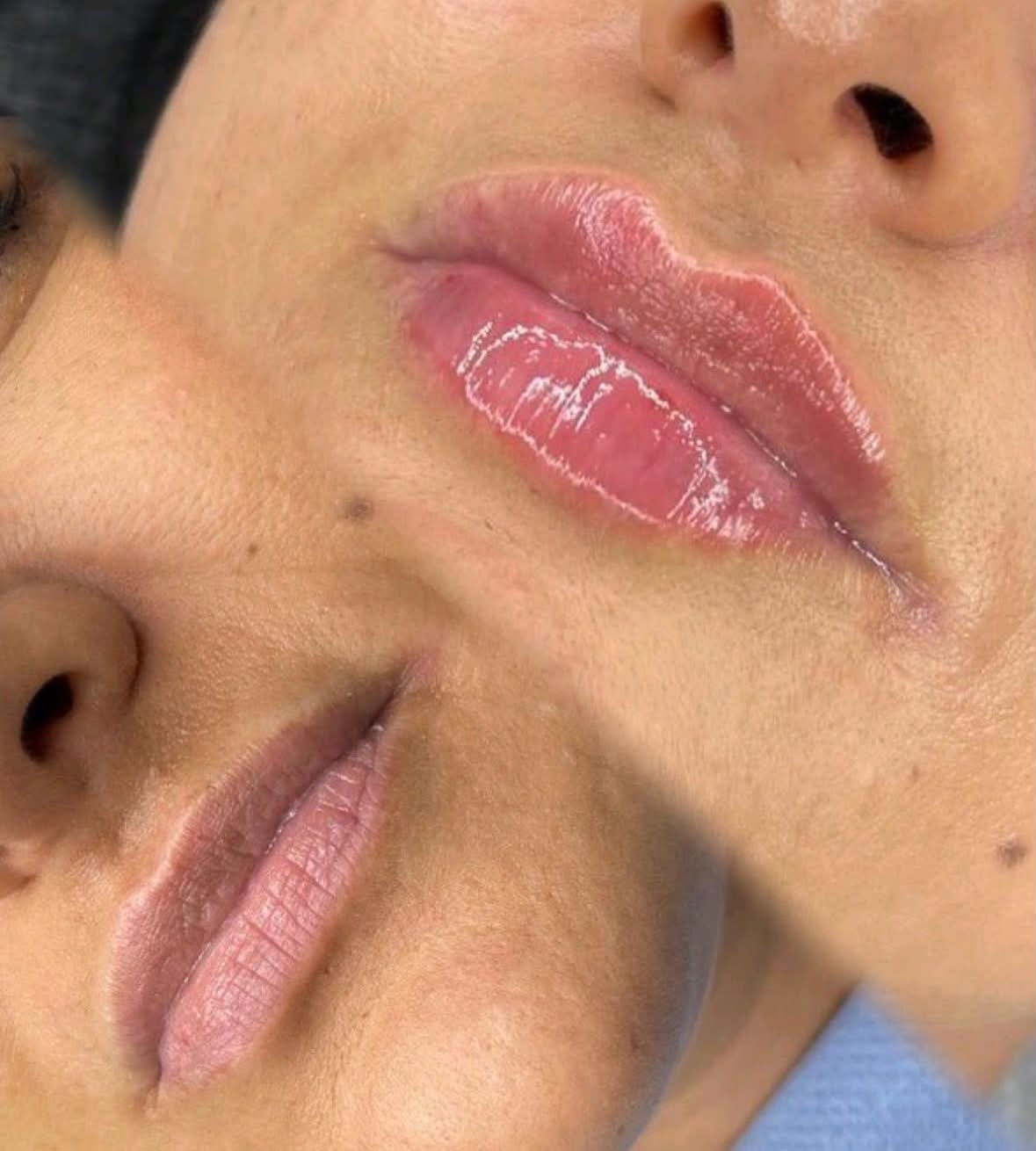 Lip filler before and after, showing a fuller, balanced shape