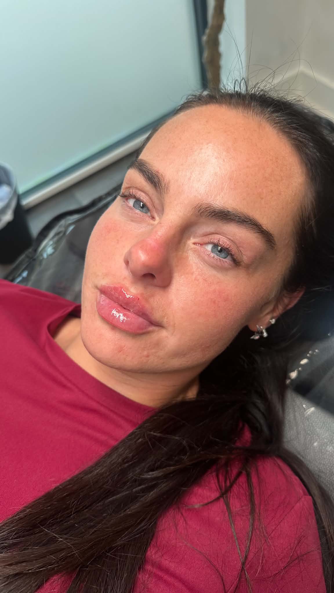 Client in the treatment chair after lip filler, showing a soft, natural finish