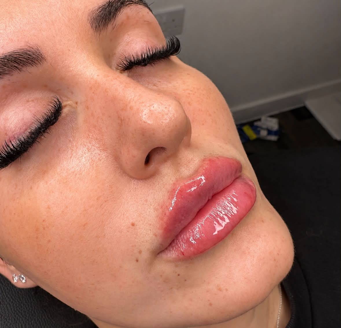 Lip filler result, natural volume with a defined border