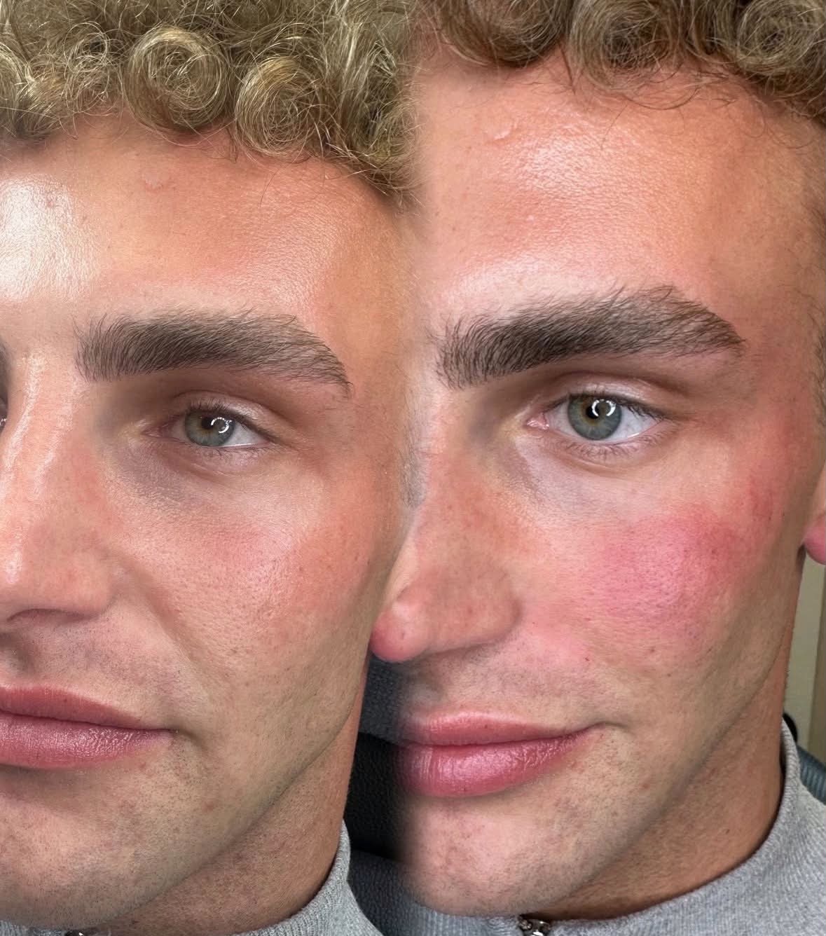 Skin treatment before and after