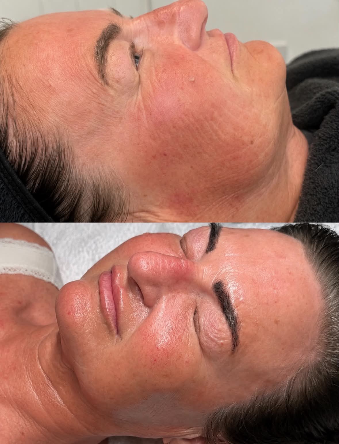 Skin quality before and after a course of treatment, showing improved texture