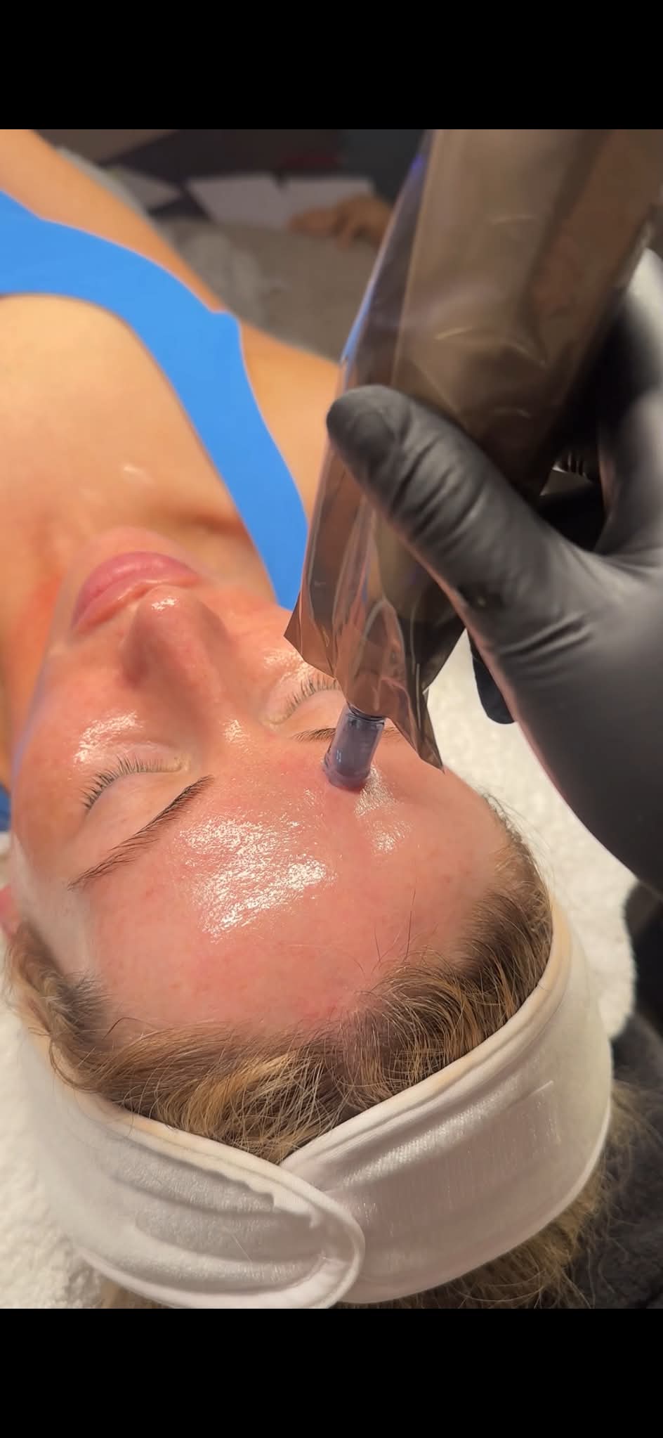 A microneedling treatment in progress, shown close up